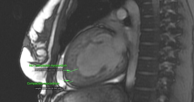 File:Non-compaction of the left ventricle (Radiopaedia 38868-41063 2 CH SSFP 1).jpg