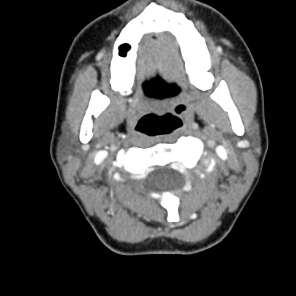 File:Normal CT of the neck (Radiopaedia 14575-14500 Axial C+ 25).jpg