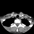 Normal CT of the neck (Radiopaedia 14575-14500 Axial C+ 59).jpg