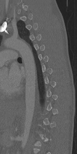 File:Normal CT thoracic spine (Radiopaedia 40181-42688 Sagittal bone window 20).png