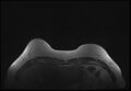Normal breast MRI - dense breasts (Radiopaedia 80454-93850 Axial T1 25).jpg