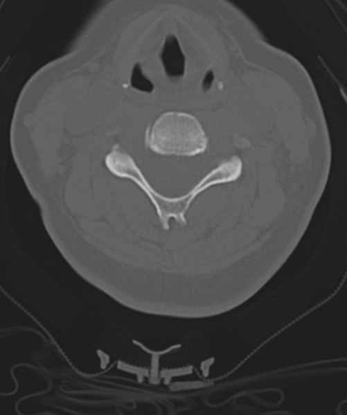 File:Normal cervical spine MRI (including Dixon) (Radiopaedia 42762-45926 Axial bone window 30).png