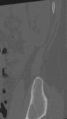 Normal lumbar spine CT (Radiopaedia 46533-50986 Sagittal bone window 3).png