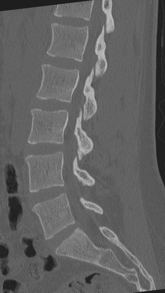 File:Normal lumbar spine CT (Radiopaedia 46533-50986 Sagittal bone window 45).png