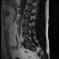 Normal lumbar spine MRI (Radiopaedia 35543-37039 Sagittal T2 3).png