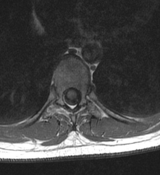 File:Normal thoracic spine MRI (Radiopaedia 41033-43781 Axial T1 9).jpg