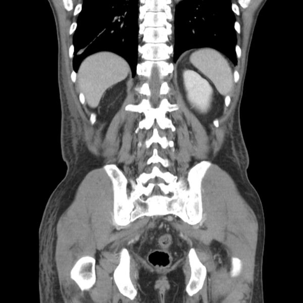File:Obstructive bladder transitional cell carcinoma (Radiopaedia 9825-10410 B 23).jpg