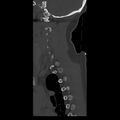 Occipital condyle fracture (Radiopaedia 31755-32691 Sagittal bone window 6).jpg