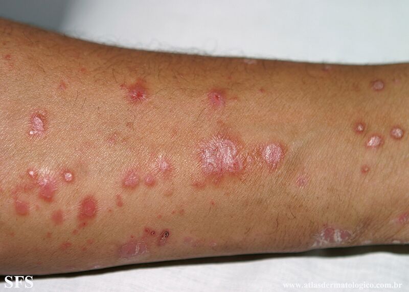File:Psoriasis (Dermatology Atlas 126).jpg