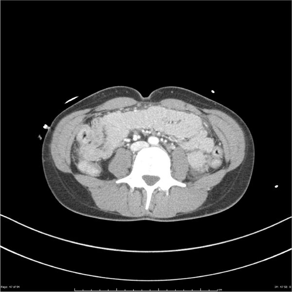 File:Traumatic renal artery dissection and pancreatic transection (Radiopaedia 37061-38739 Axial 209).jpg